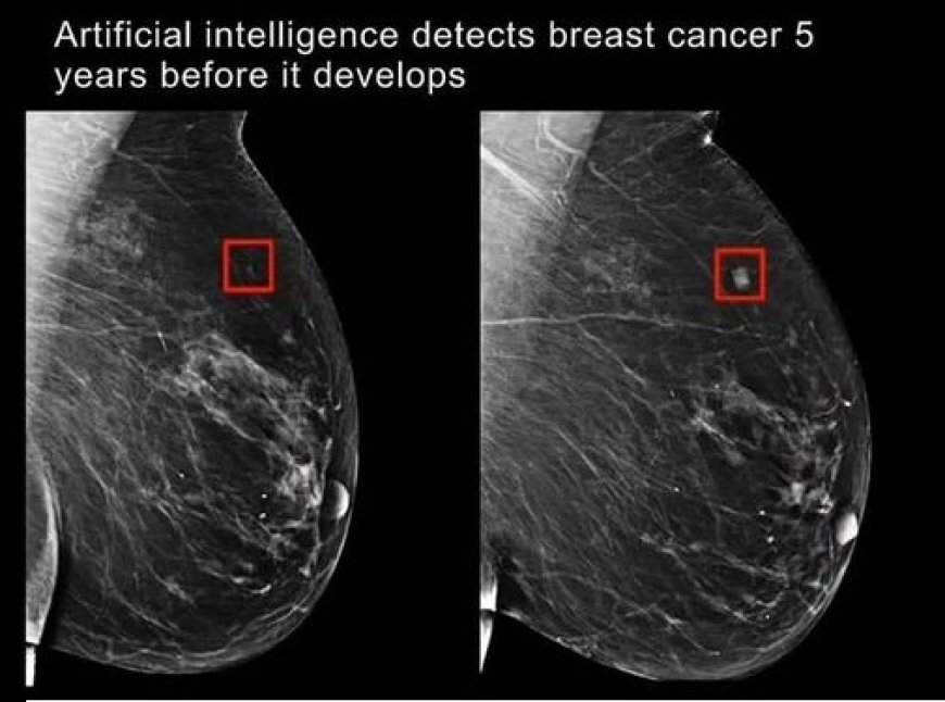 L'intelligence artificielle détecte le cancer cinq ans avant qu'il ne survienne !!